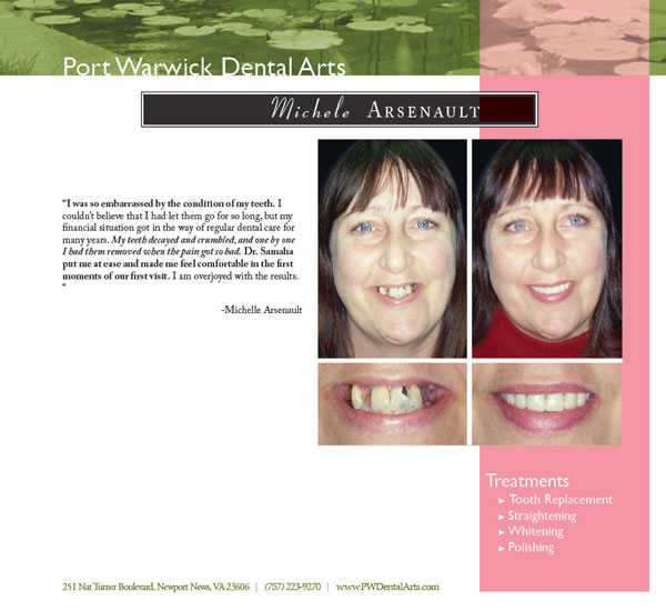 Before and After Cosmetic Dentistry Newport News Restorative