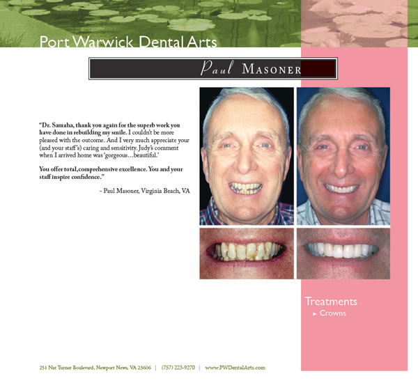 Before and After Cosmetic Dentistry Newport News Restorative