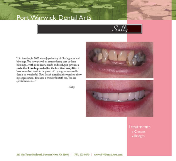 Before and After Cosmetic Dentistry Newport News Restorative