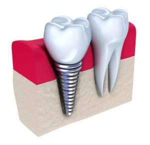 Dental Implants Hampton